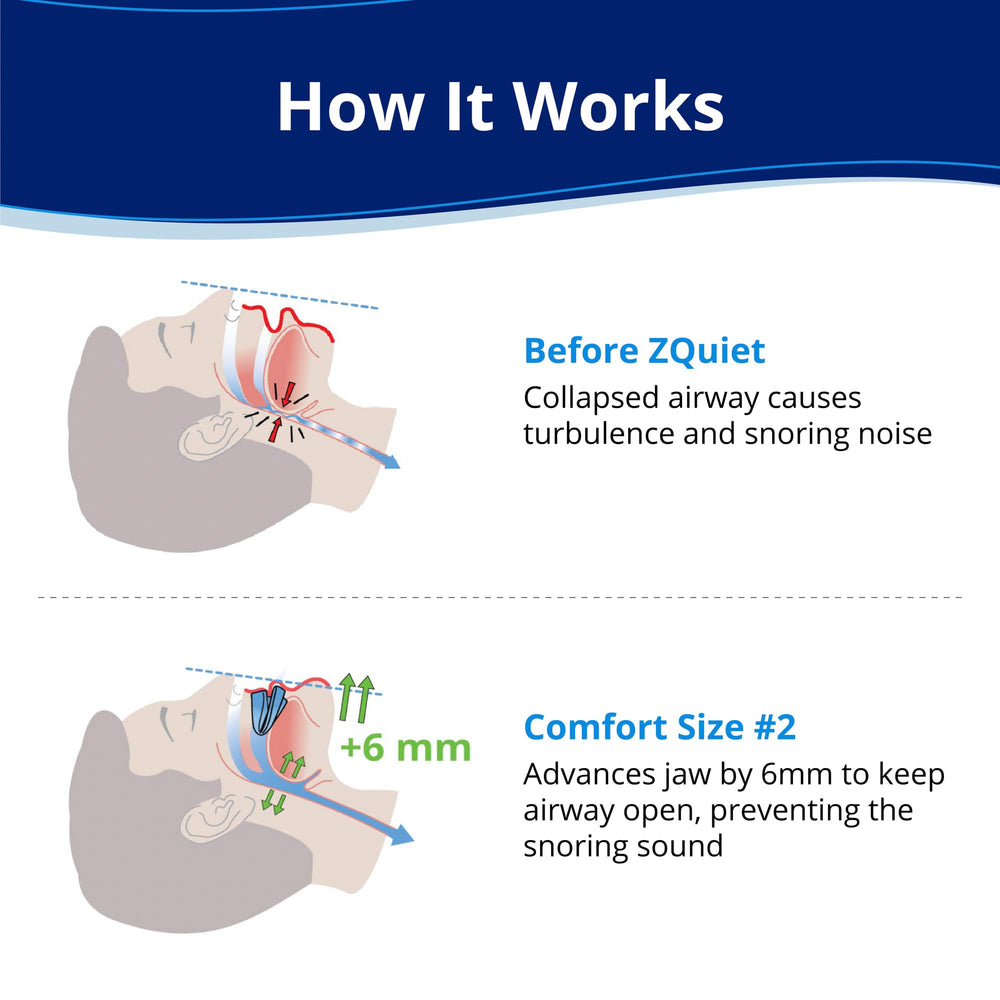 ZQuiet size 2 side profile shows jaw-forward design for snoring relief