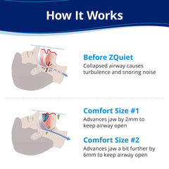 ZQuiet Size 2 mouthpiece with stronger jaw adjustment for enhanced airway support
