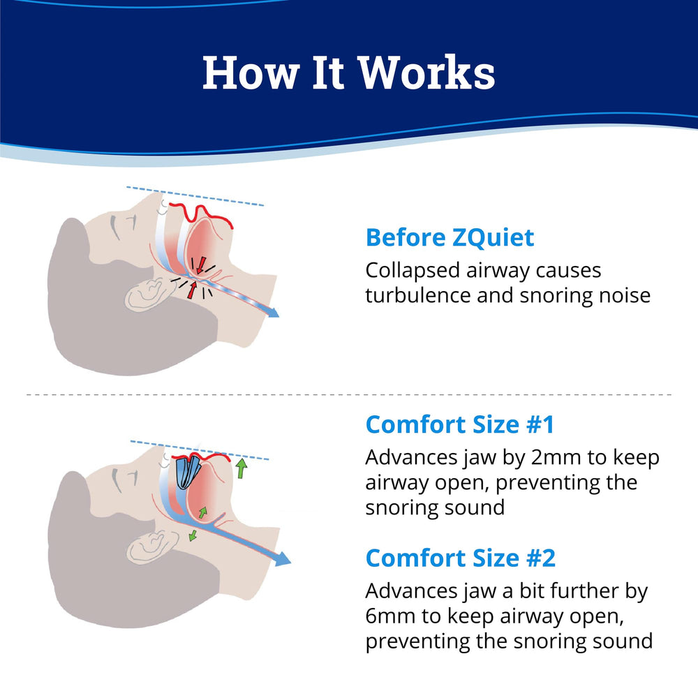 ZQuiet protective storage case keeps mouthpieces organized and clean.