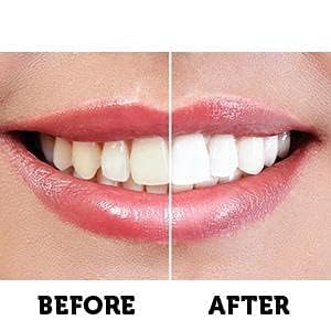 Active Wow precision tips enable targeted gel placement.