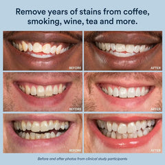Auraglow mint-flavored, enamel-safe whitening for a comfortable treatment