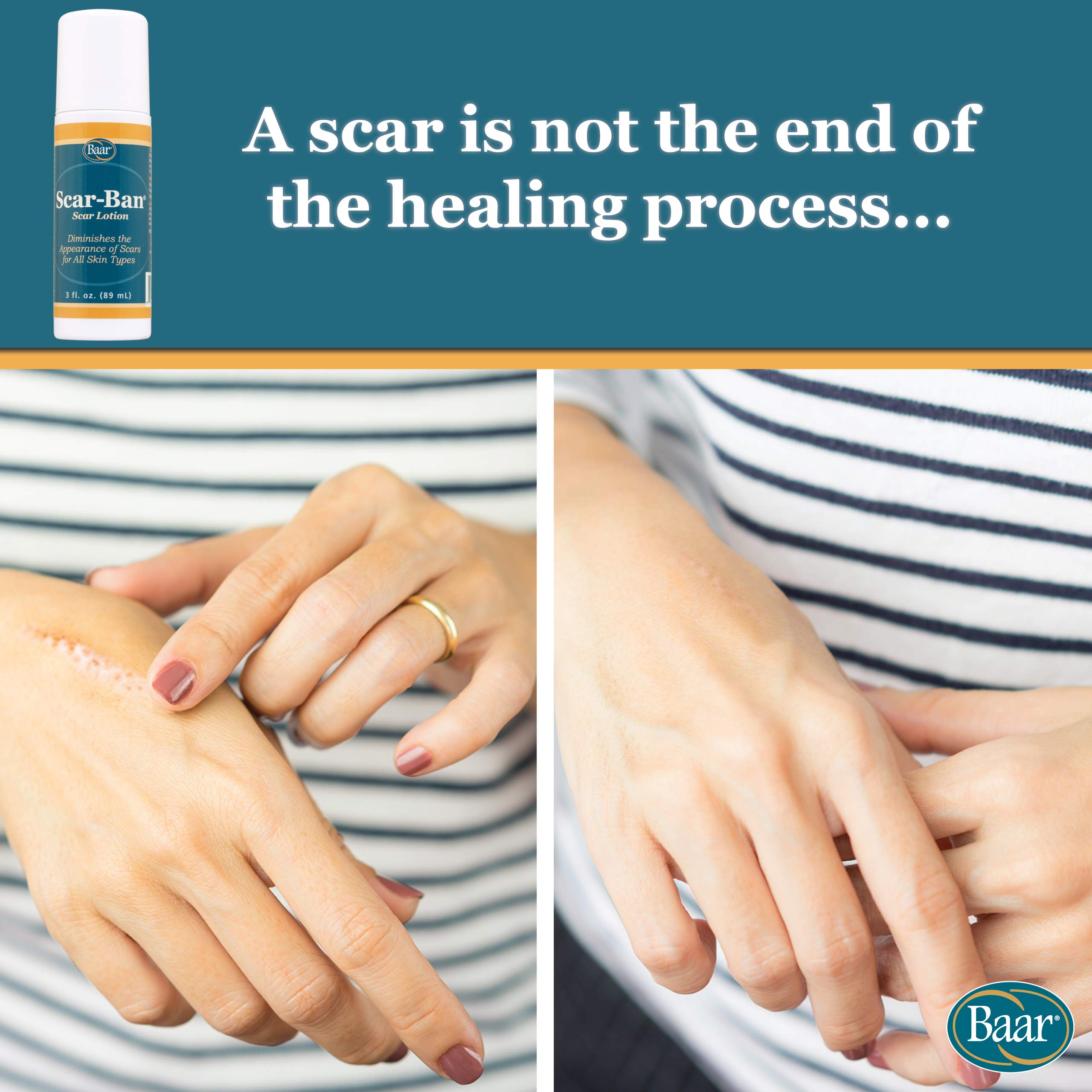 Baar Scar Ban Roll On applying angle showing easy targeted scar care