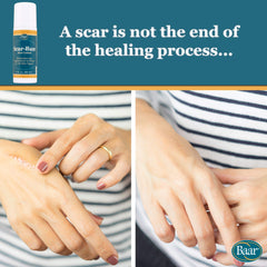 Baar Scar Ban Roll On applying angle showing easy targeted scar care