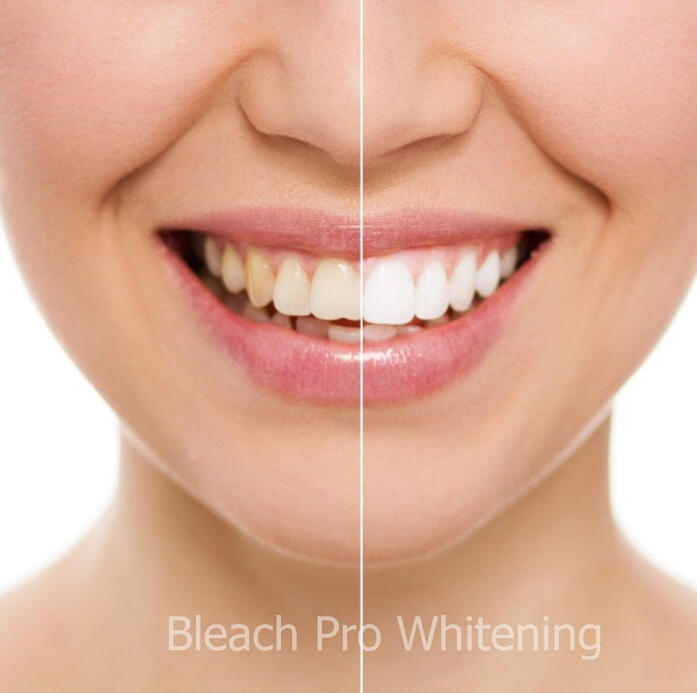 Bleach Pro Whitening gel packaging opened to reveal 3ml cartridges.