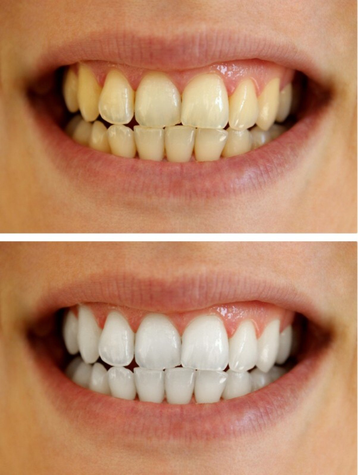 Bleach Pro Whitening gel syringe with cap removed, prepared for topical application.
