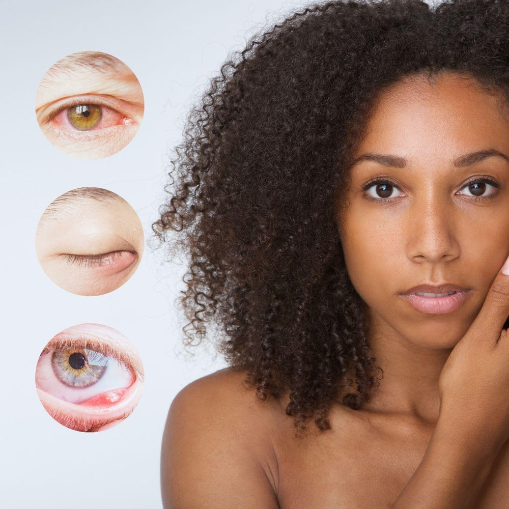 brazmedics brazzoMD Stye Relief applied to the eye area for soothing care.