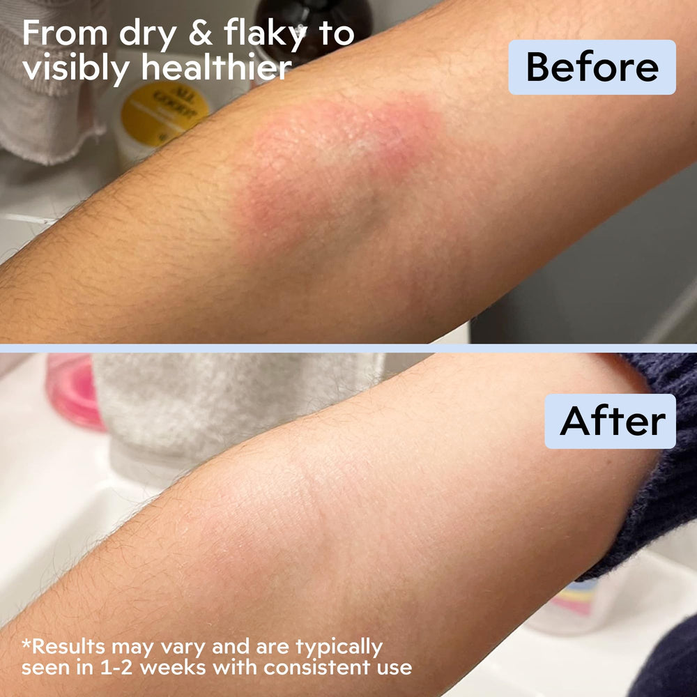 Applying Clearbody Organics Manuka Honey Cream for face and body comfort