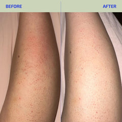 Codex Labs BIA Eczema Relief Lotion all-ages care image reinforces safety for babies to adults