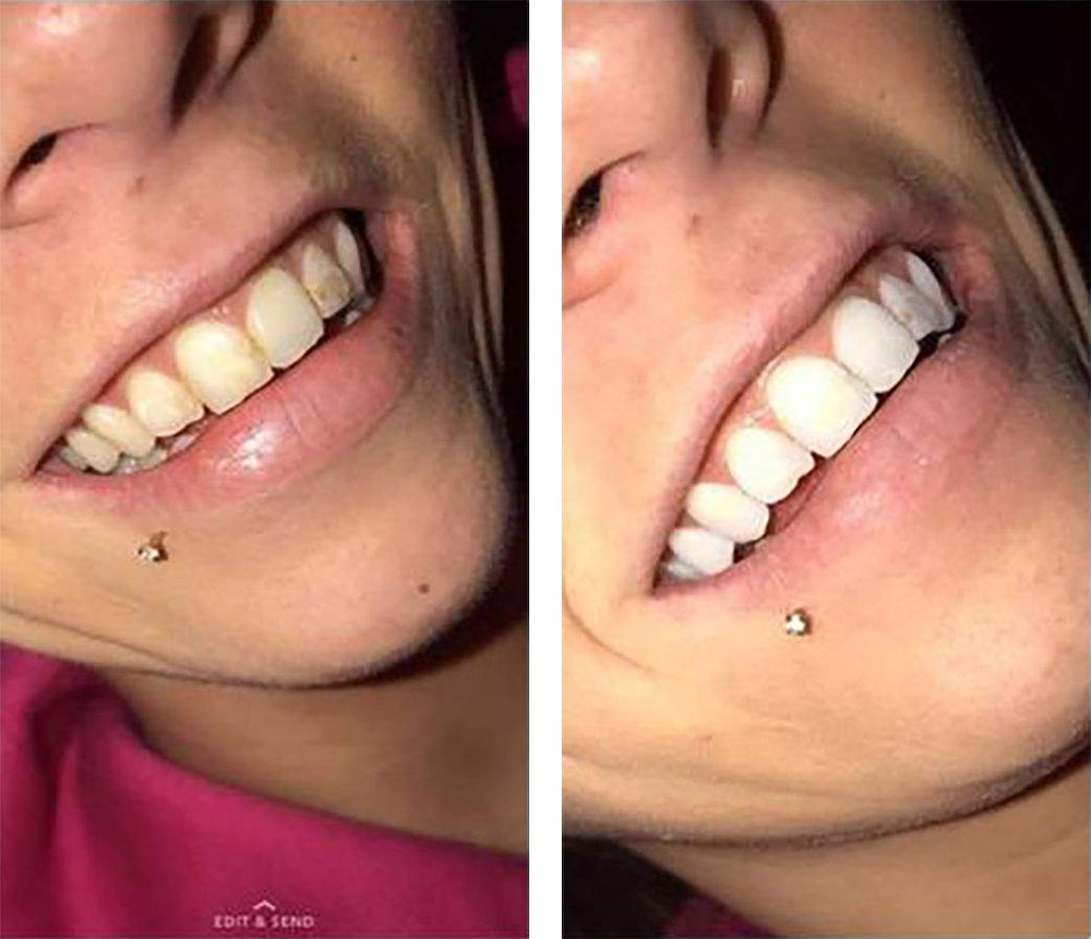 Close-up of applying COLO Color Wheel gel for even at-home whitening.