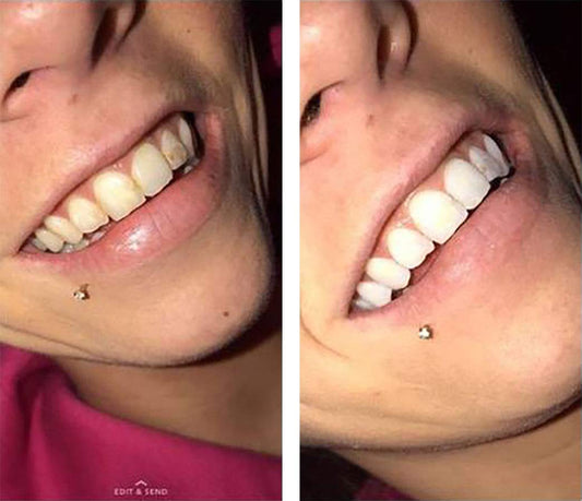 Close-up of applying COLO Color Wheel gel for even at-home whitening.
