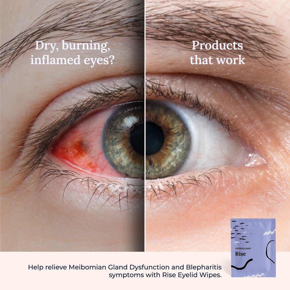 CorneaCare Rise blepharitis-support concept image for lid care