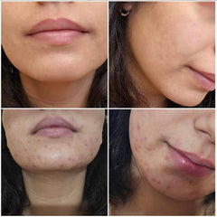 Demodexcillin Skin Solution 4.0 clinical packaging hints at professional grade care