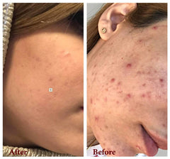 Demodexcillin Skin Solution 4.0 in a cozy routine for rosacea conscious users