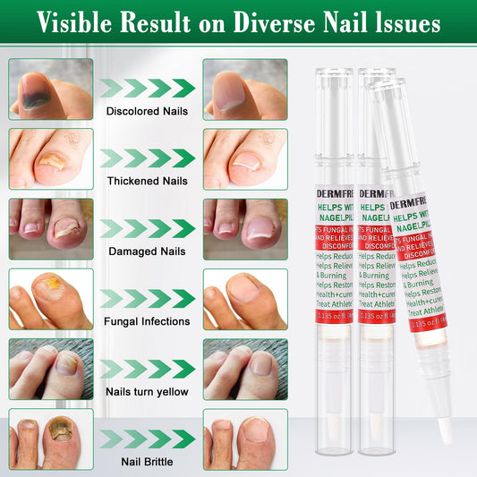 DERMFREE Toe Nail Fungus Renewal Pen application-area close-up shows targeted under-nail delivery.