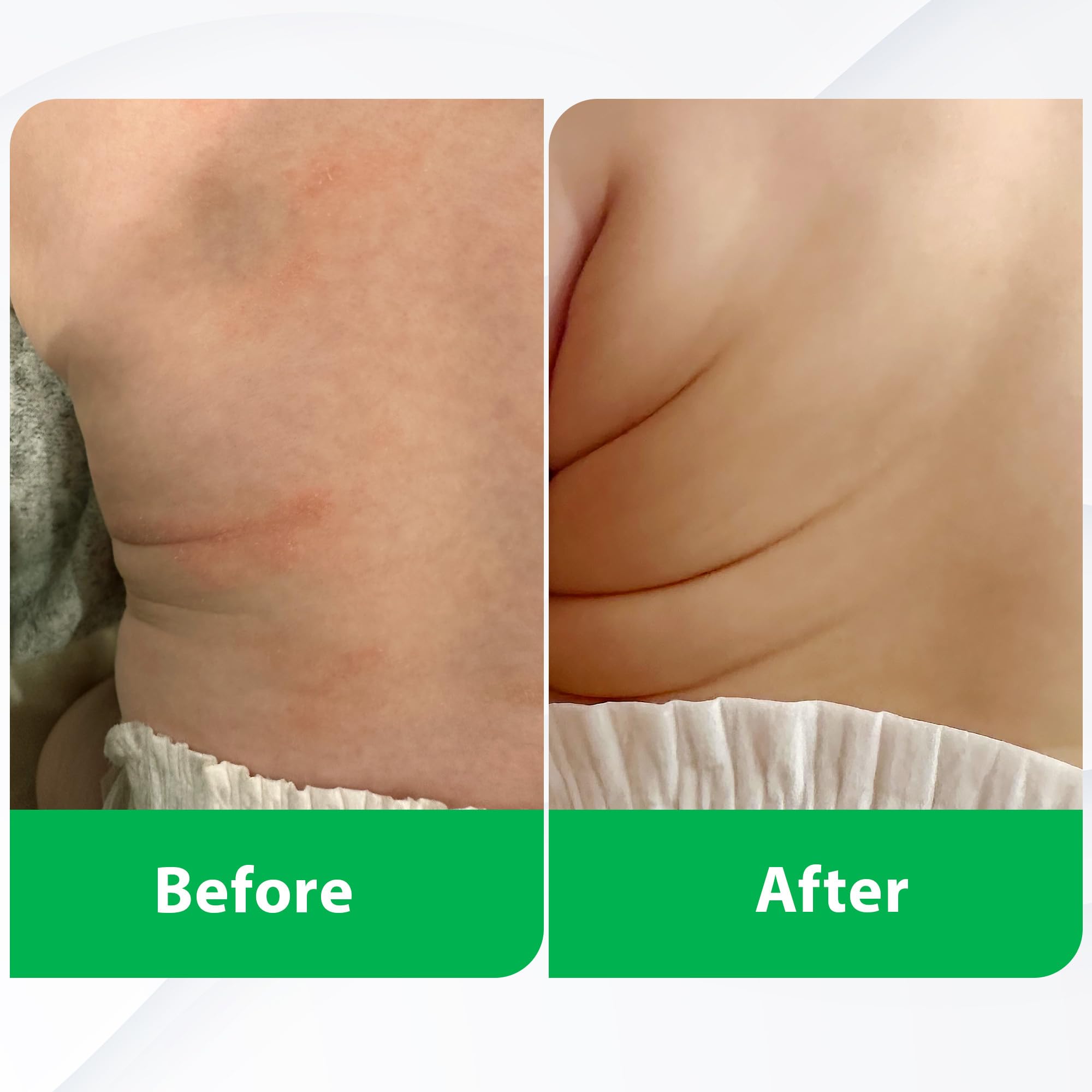 Kids-safe packaging implies family-friendly eczema relief options.
