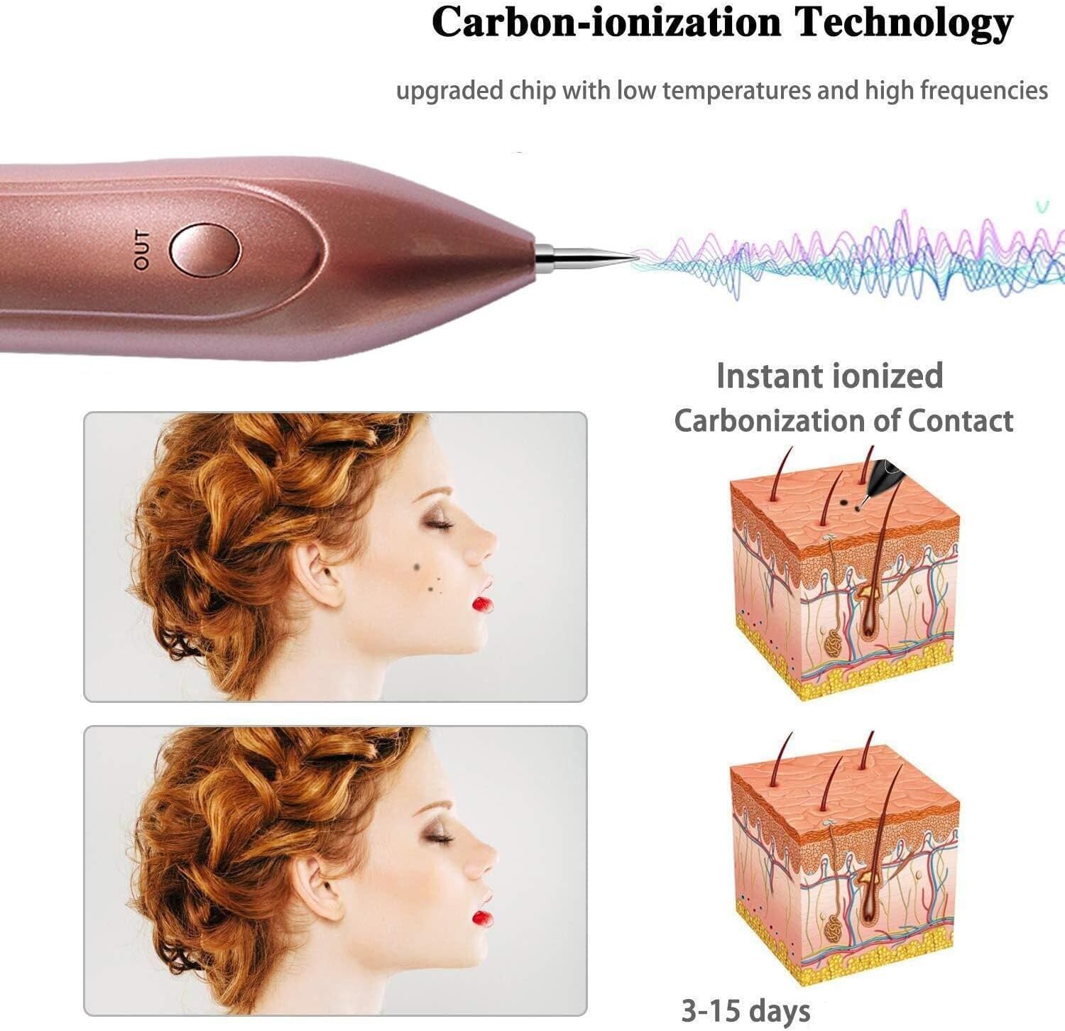 EA269RV Wart and Skin Tag Remover Pen nine precision tips for targeted treatment