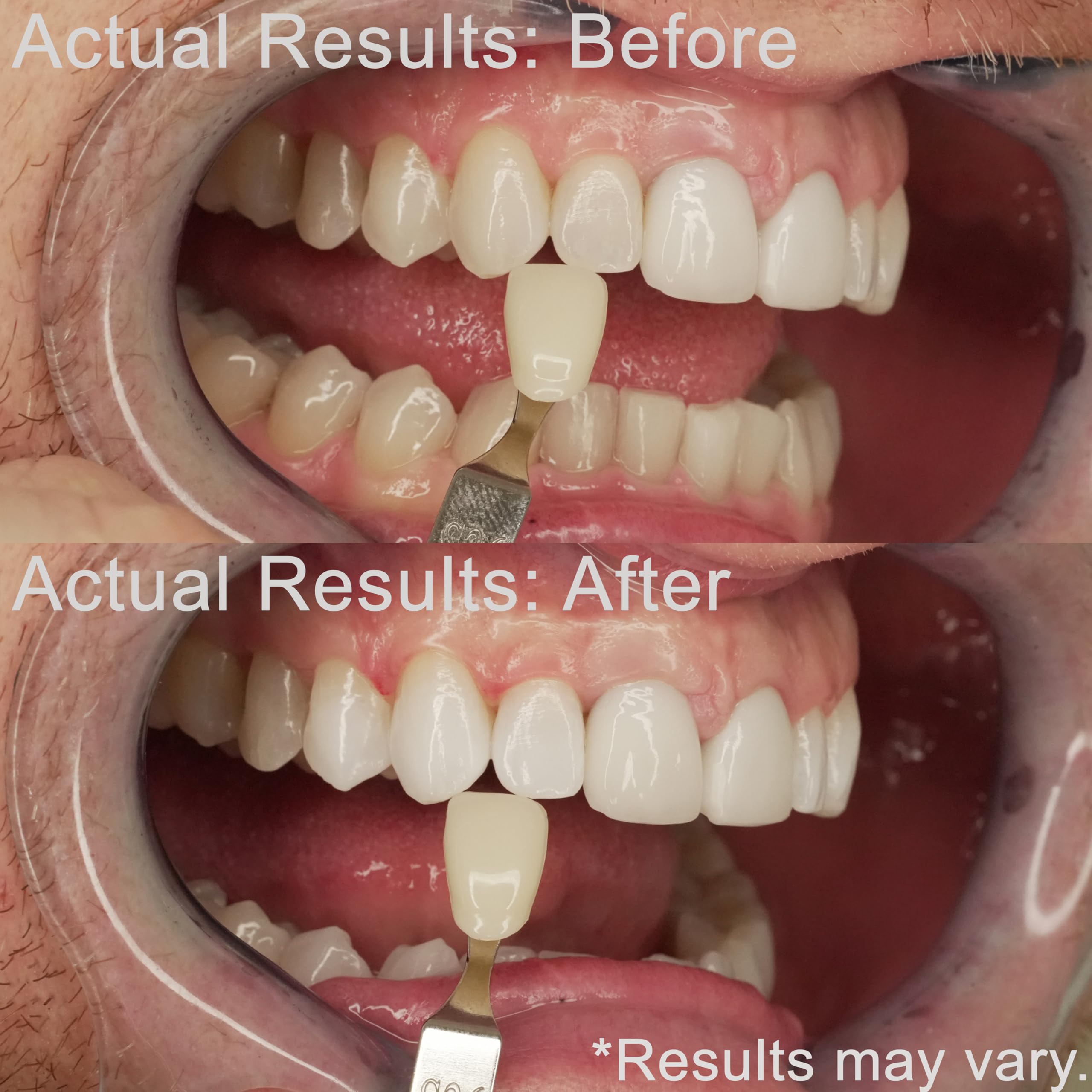 EZZI result photo shows brighter smile after use
