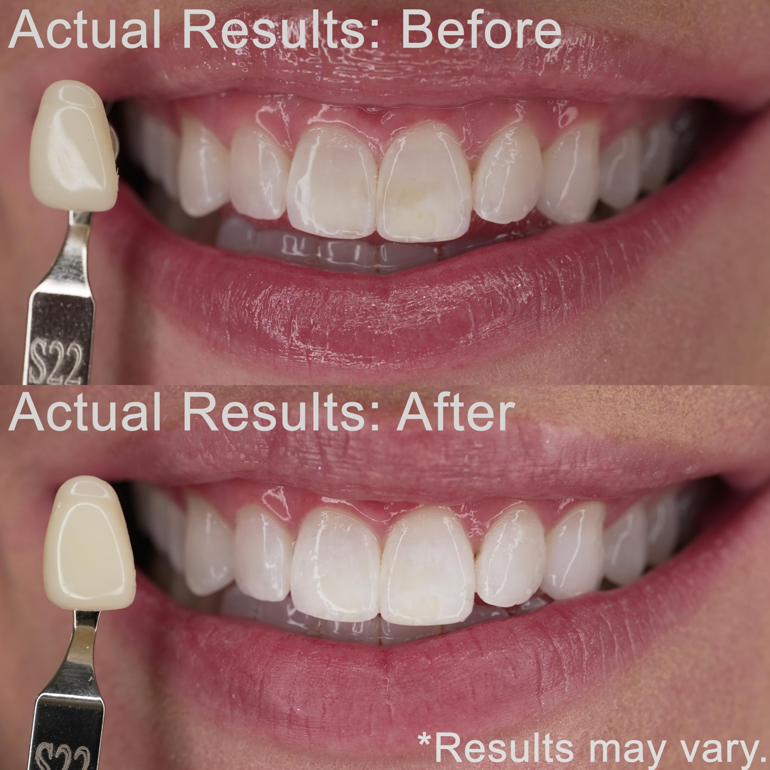 EZZI 10% carbamide peroxide gel close-up for sensitive teeth