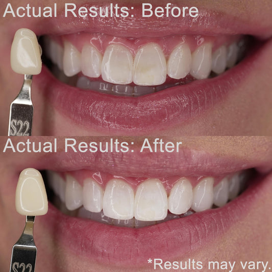 EZZI 10% carbamide peroxide gel close-up for sensitive teeth