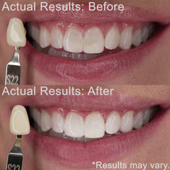 EZZI 10% carbamide peroxide gel close-up for sensitive teeth