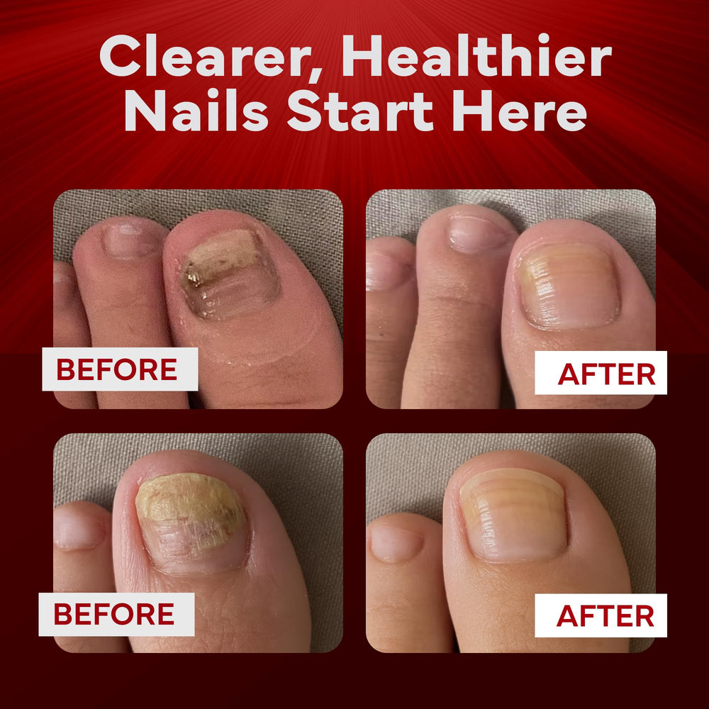 EMUAIDMAX nail appearance with clearer nails over time.