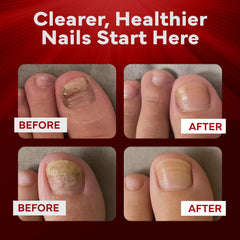EMUAIDMAX nail appearance with clearer nails over time.