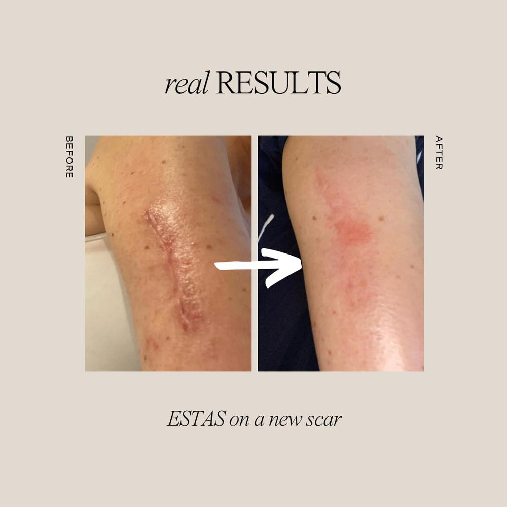 ESTAS Beauty Scar Cream applied to body areas for versatile scar care.