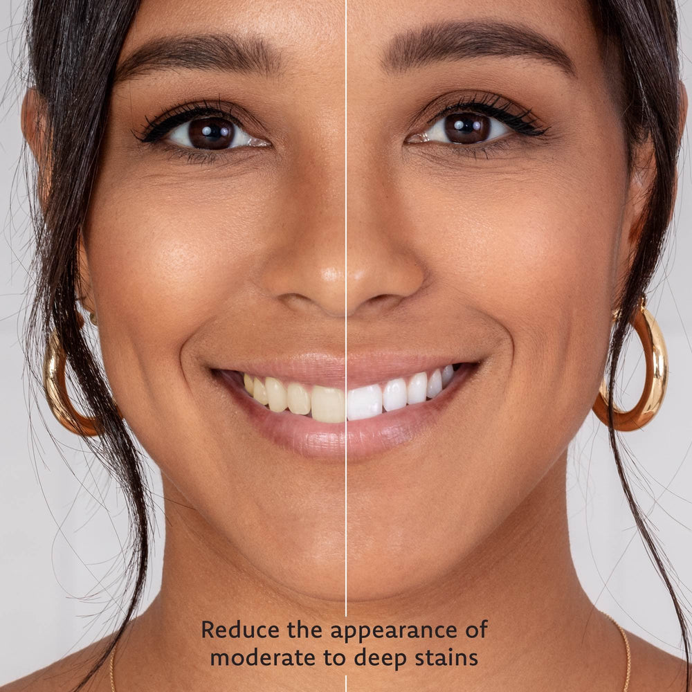 Everest VAAS 35% carbamide peroxide gel image highlights whitening strength