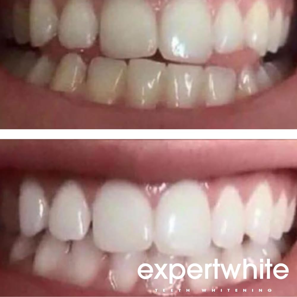 Close-up of Expertwhite 3cc syringe for accurate dosing.