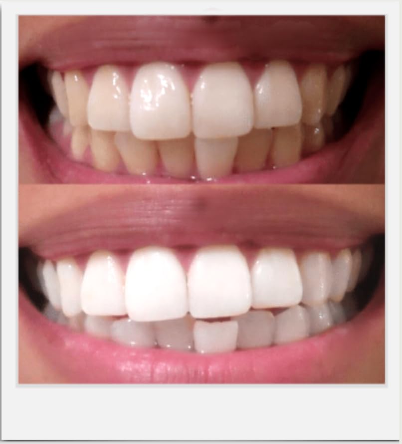 Expertwhite helps remove coffee and tea stains over time.