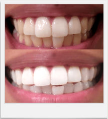 Expertwhite helps remove coffee and tea stains over time.