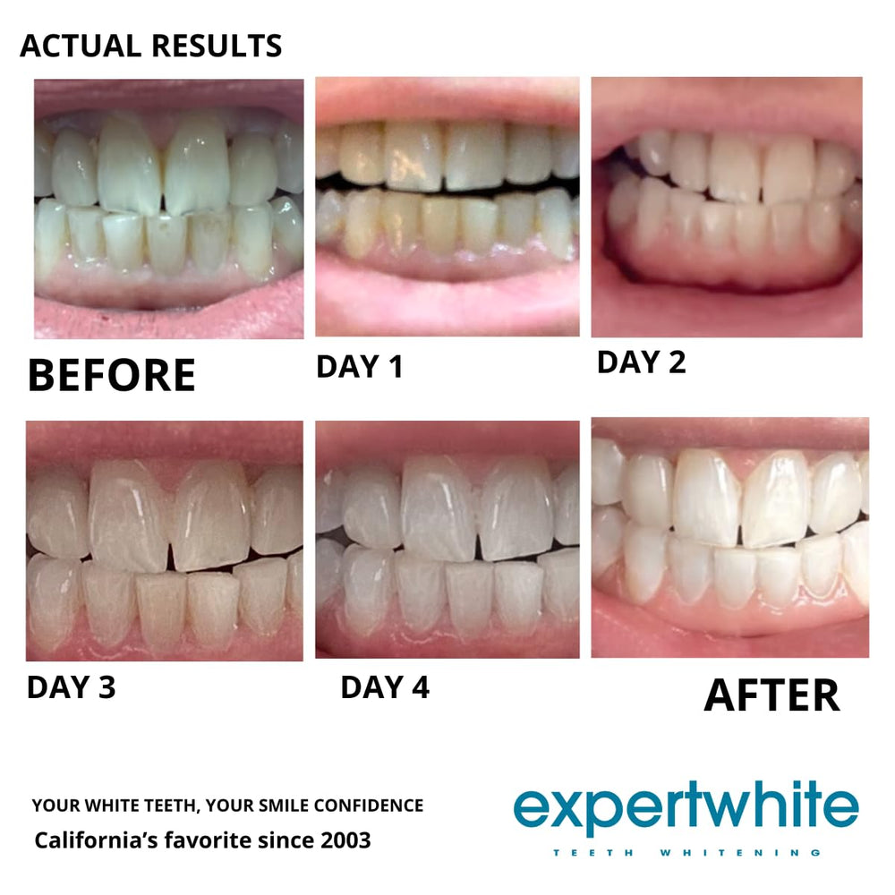 Custom or universal trays with Expertwhite for even tooth whitening