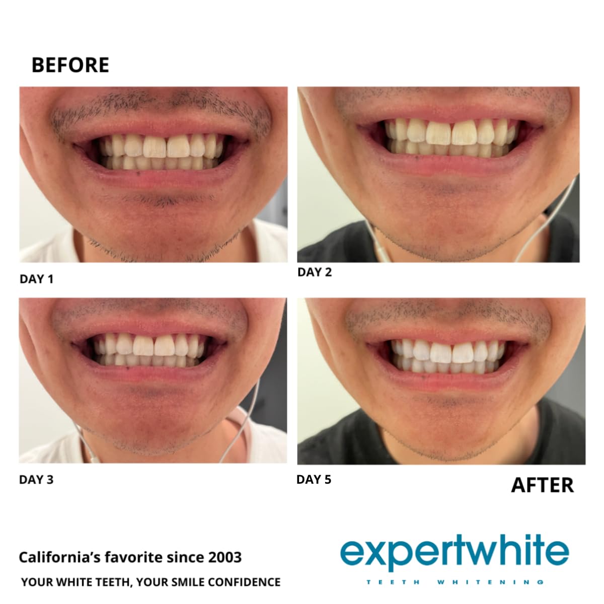 At-home whitening setup using Expertwhite gel and trays for consistent results