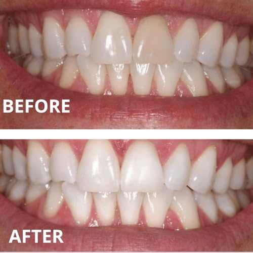 Expertwhite gel compatible with custom trays like Invisalign.