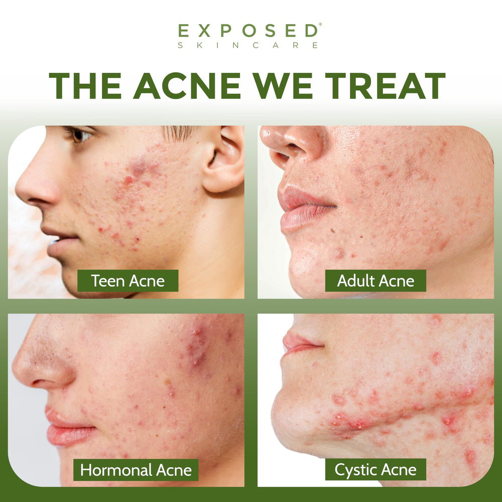 Exposed Skin Care capsules resting on a surface for daily skin and gut health.