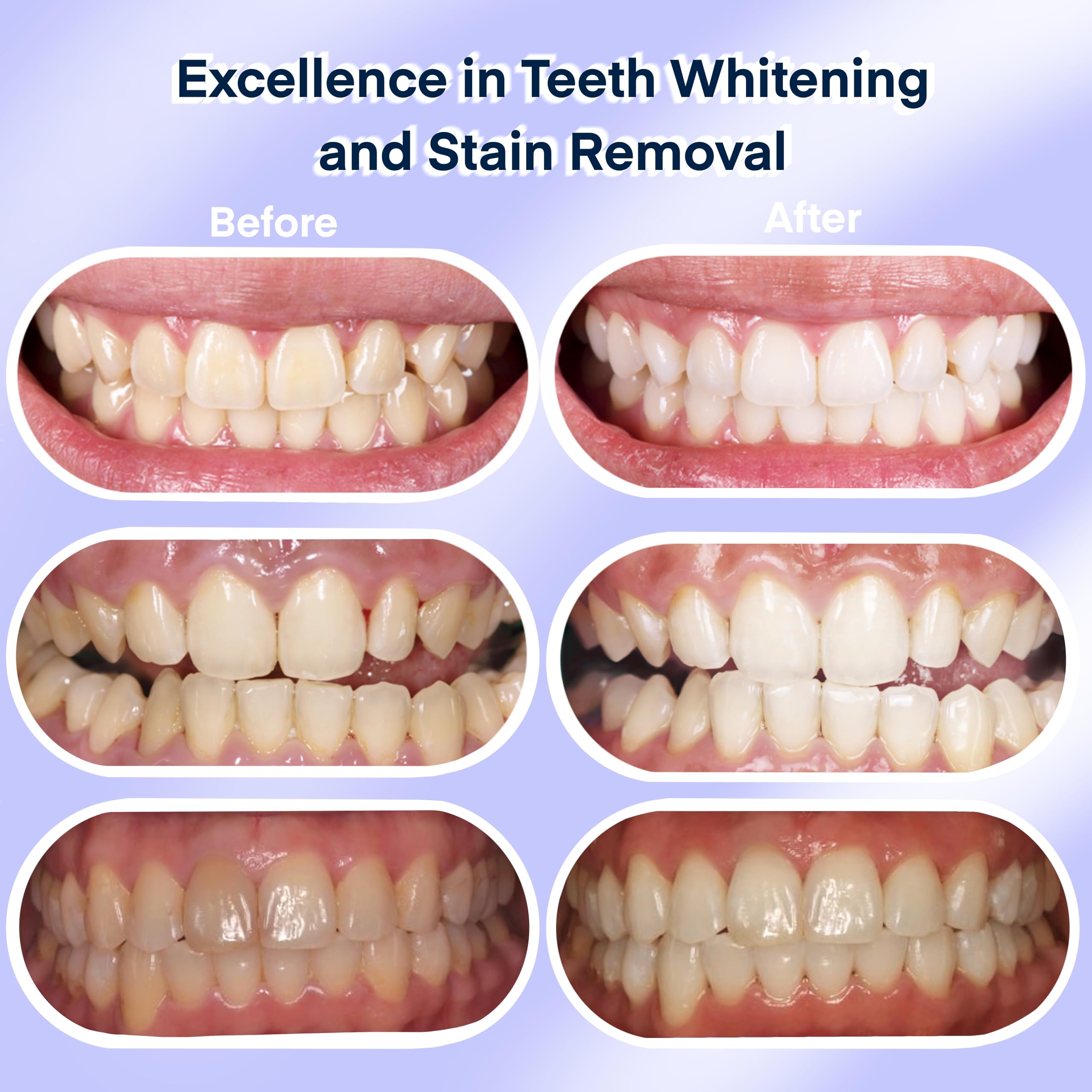 Fabulshine cordless LED device enables flexible whitening sessions.