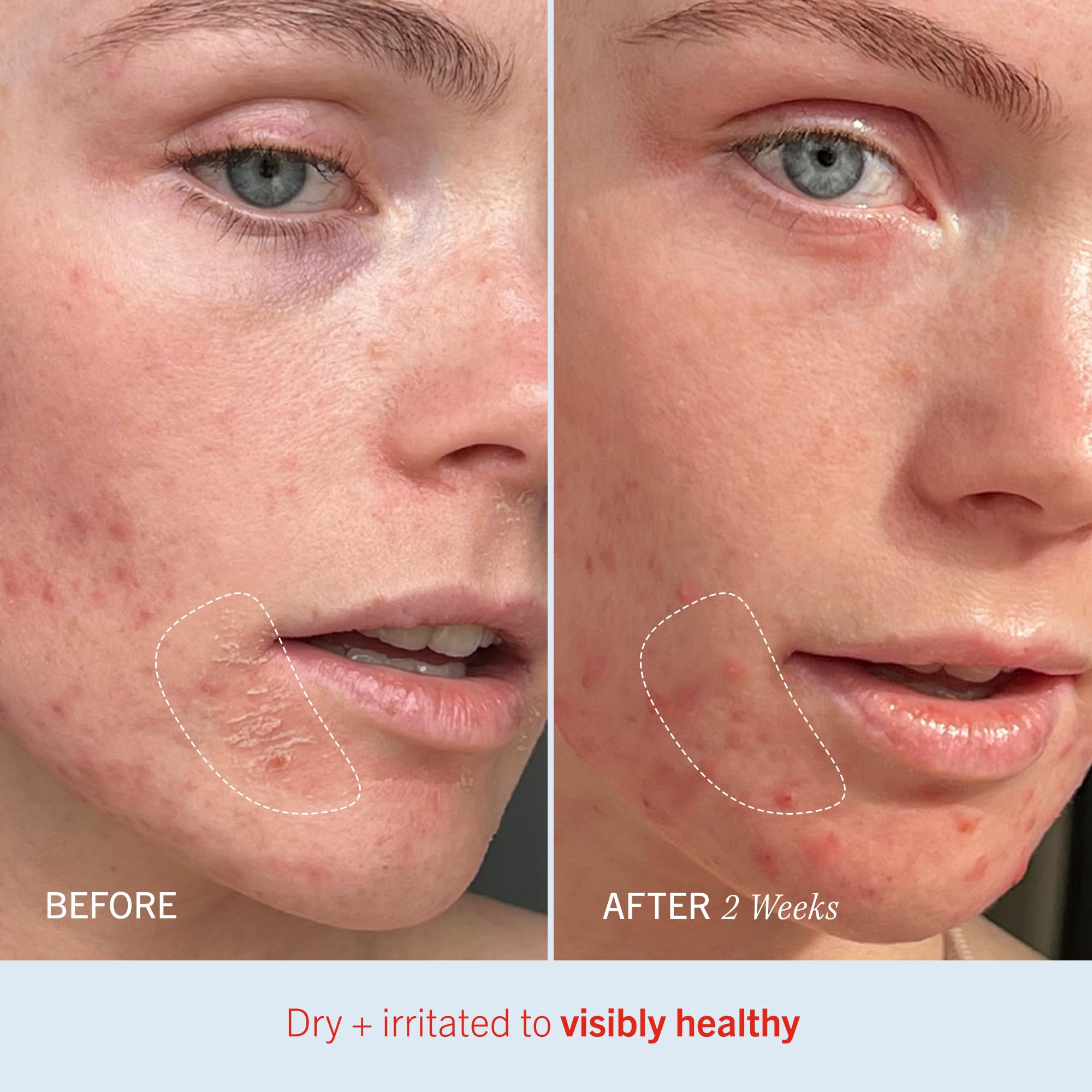 First Aid Beauty Ultra Repair Cream free-from formula excludes fragrance and alcohol.