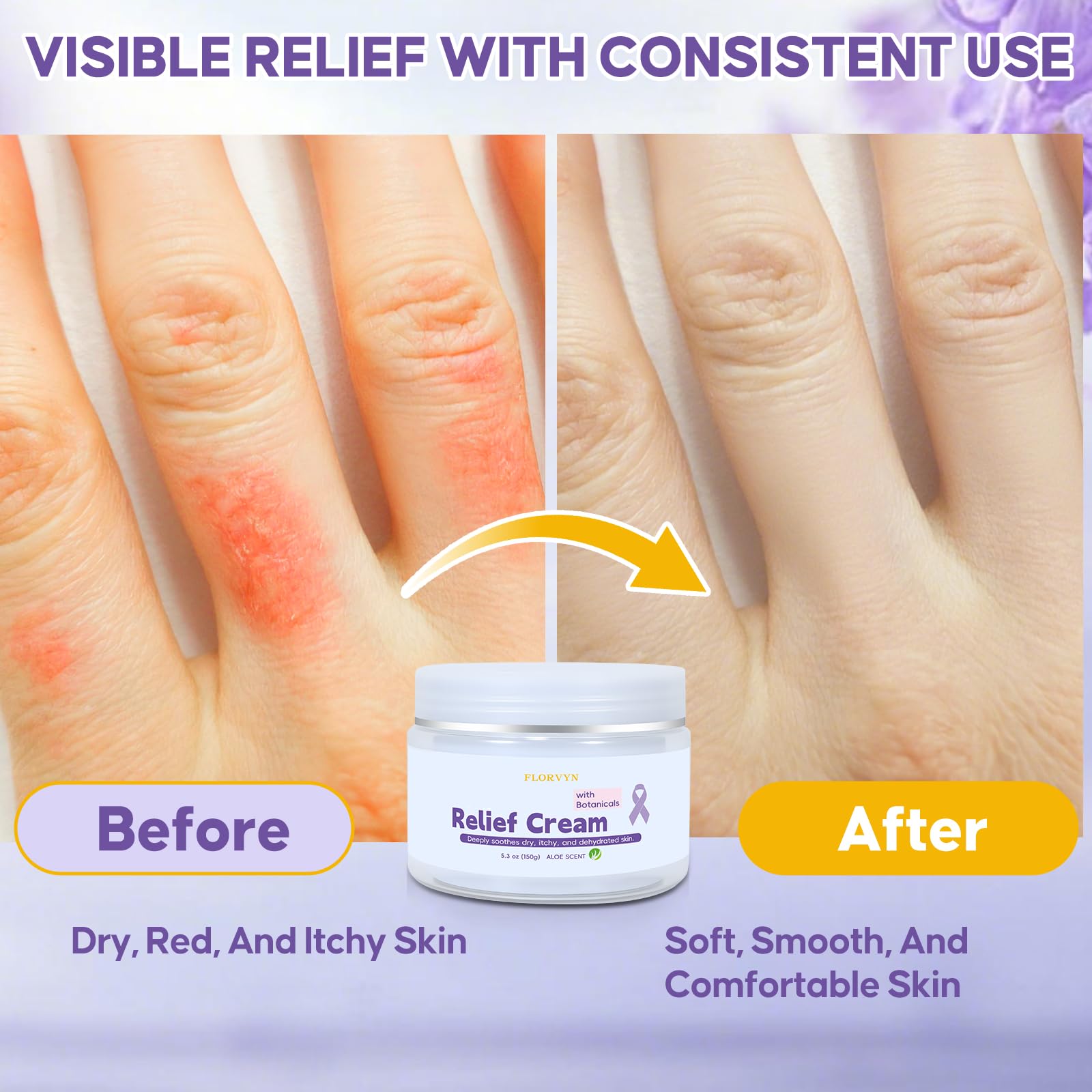 Florvyn jar shown for generous 150g daily moisturizer and ongoing comfort.