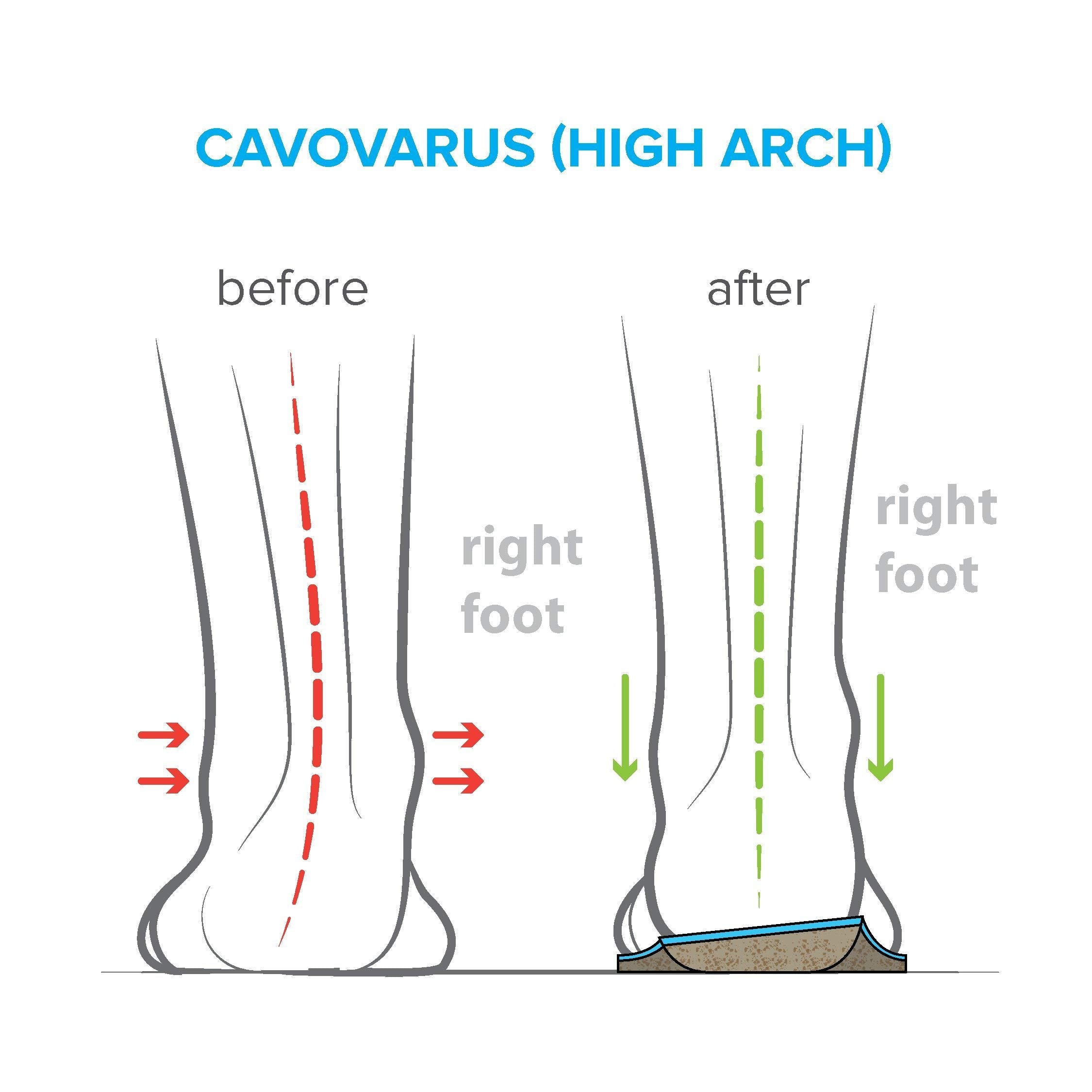 FootScientific Arches Type 3 Stay Dry mesh for moisture and odor control.