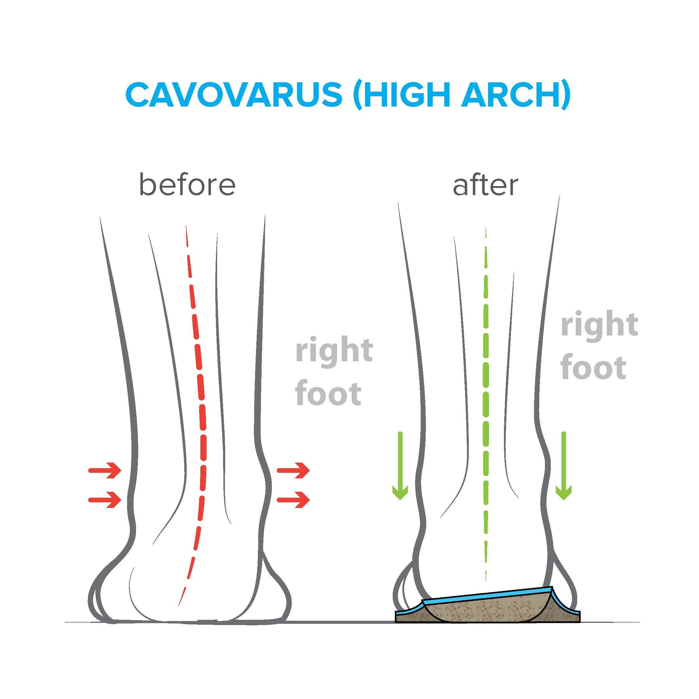 FootScientific Arches Type 3 Stay Dry Mesh helps odor control during workouts