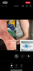 Generic Indigo Blue Ointment 8oz in use during first aid scenario