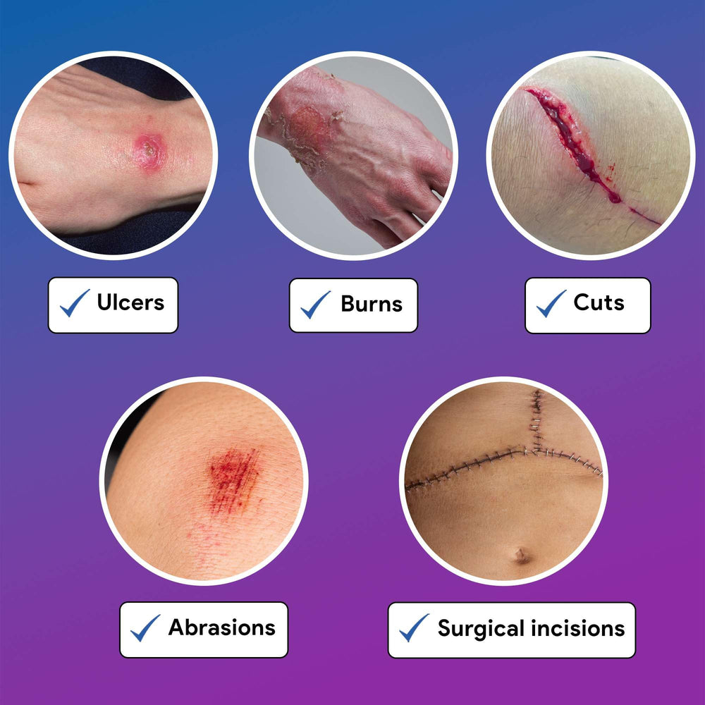 Gentell Select wound care for ulcers and donor sites: hydrated wounds, durable protection
