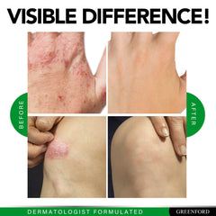 Greenford Eczema Support packaging on desk indicates USA-made quality.