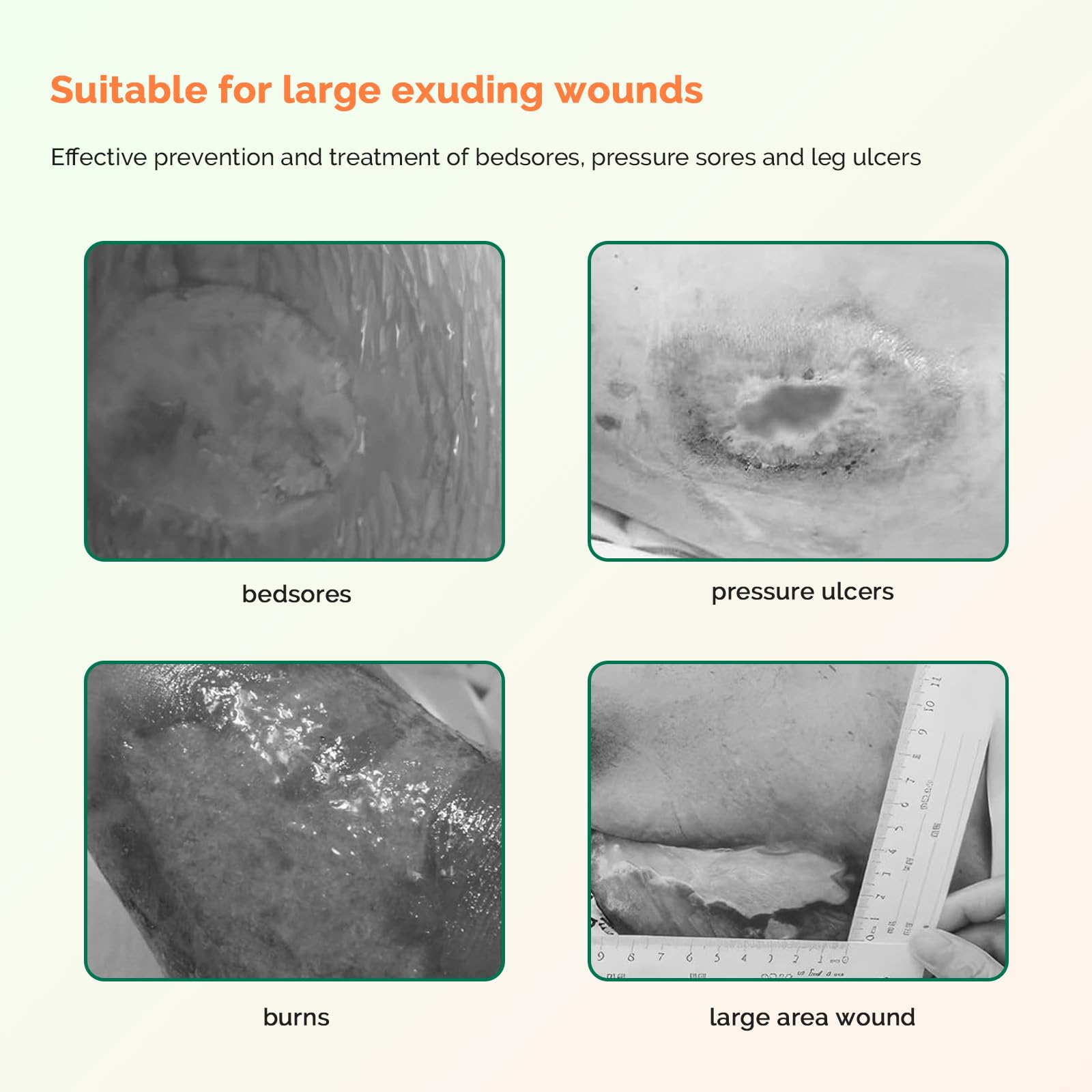 Greetmed sacral wound care dressing applied to sacral area in clinical setting
