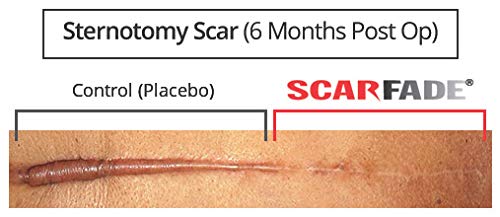 Hanson Silicone Scar Ointment cream texture appears smooth
