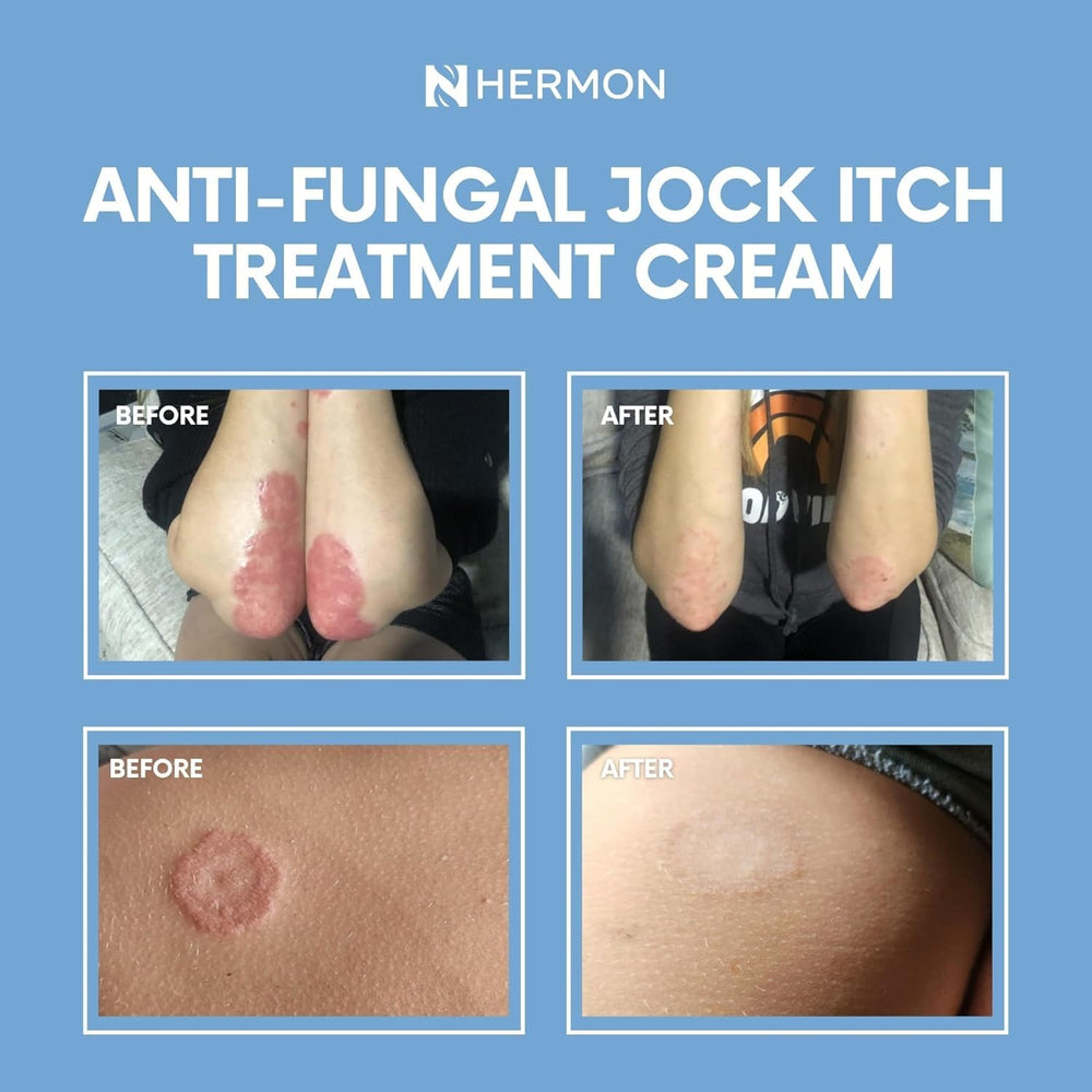 Hermon Jock Itch Cream after-use look suggests comfortable skin.