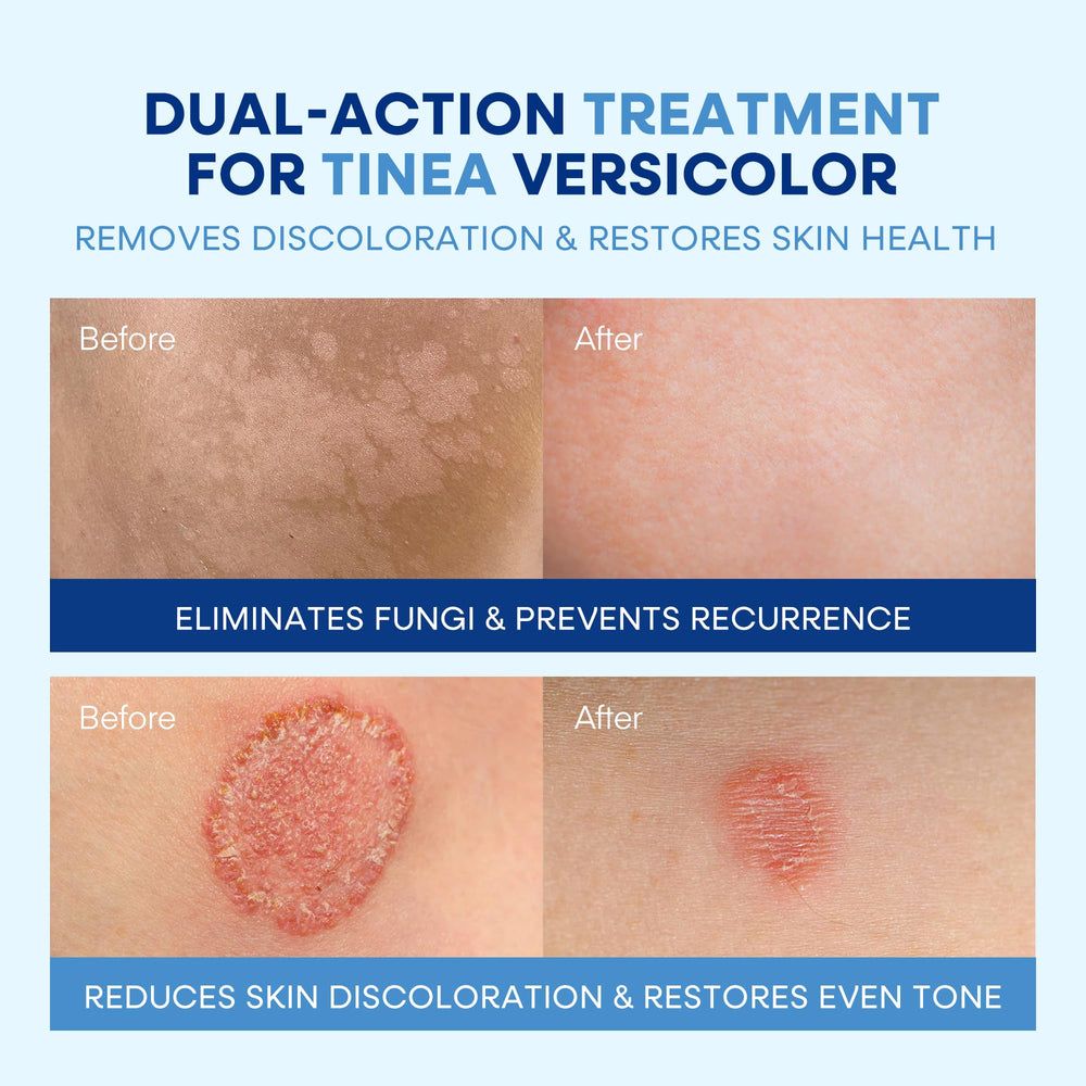 Hermon Tinea Versicolor Kit Box shows two-step treatment for fungal skin concerns.