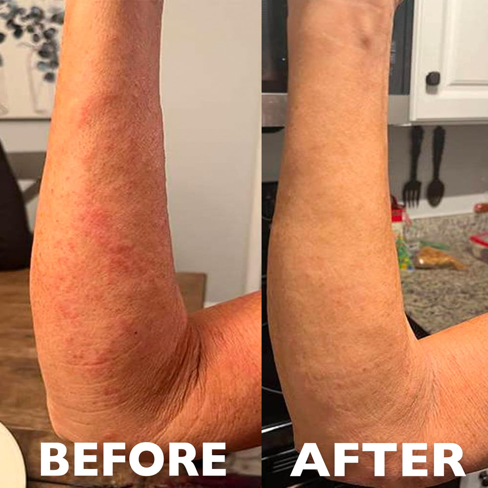Hey Honey 911 Propolis Gel applied to skin for soothing relief