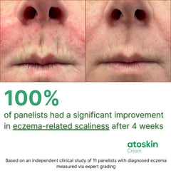 Hands applying HVSun Atoskin eczema cream during irritation for quick comfort