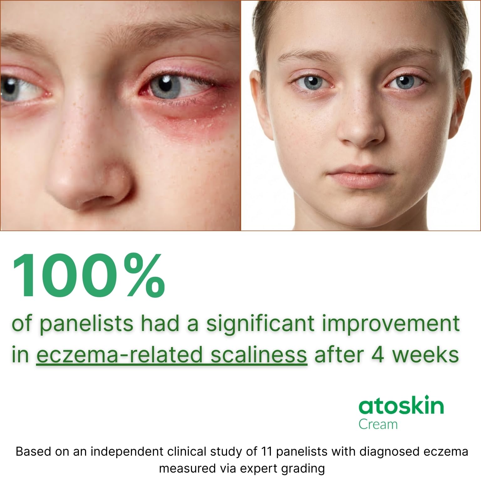 HVSun Atoskin eczema cream skin close-up reveals a rich, moisturizing formula.